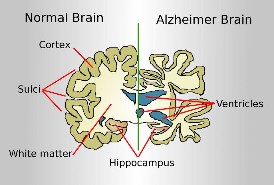 Alzheimer hastalığı